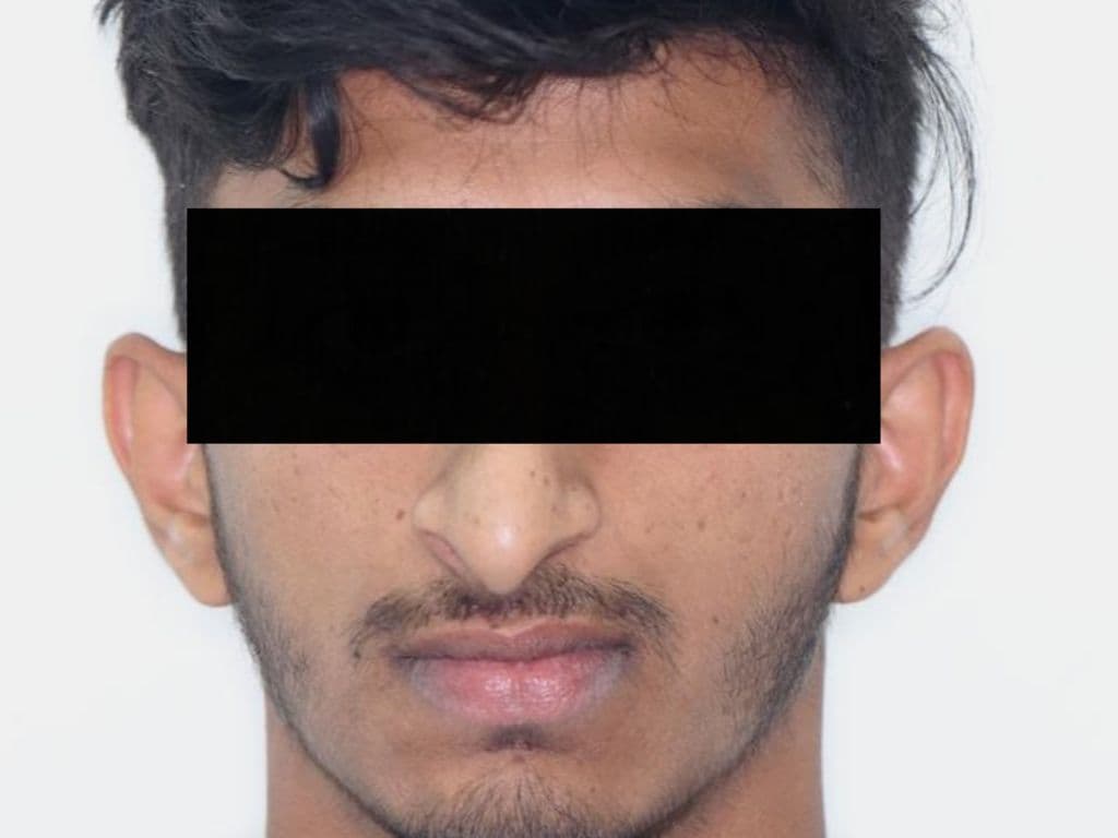 After - Quad Zygomatic Implants