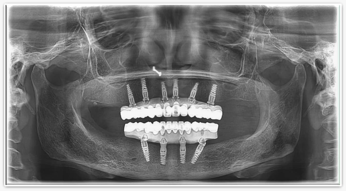 Full Arch Implants & Bite Rehabilitation