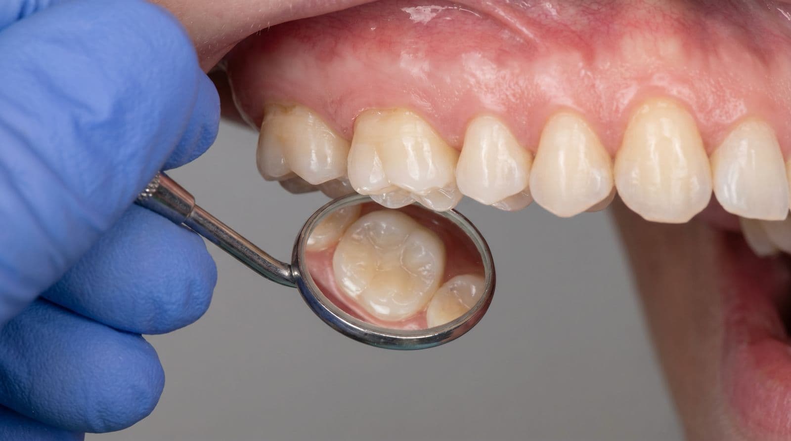 Tooth-Colored Dental Fillings at Maxface Clinic Bangalore