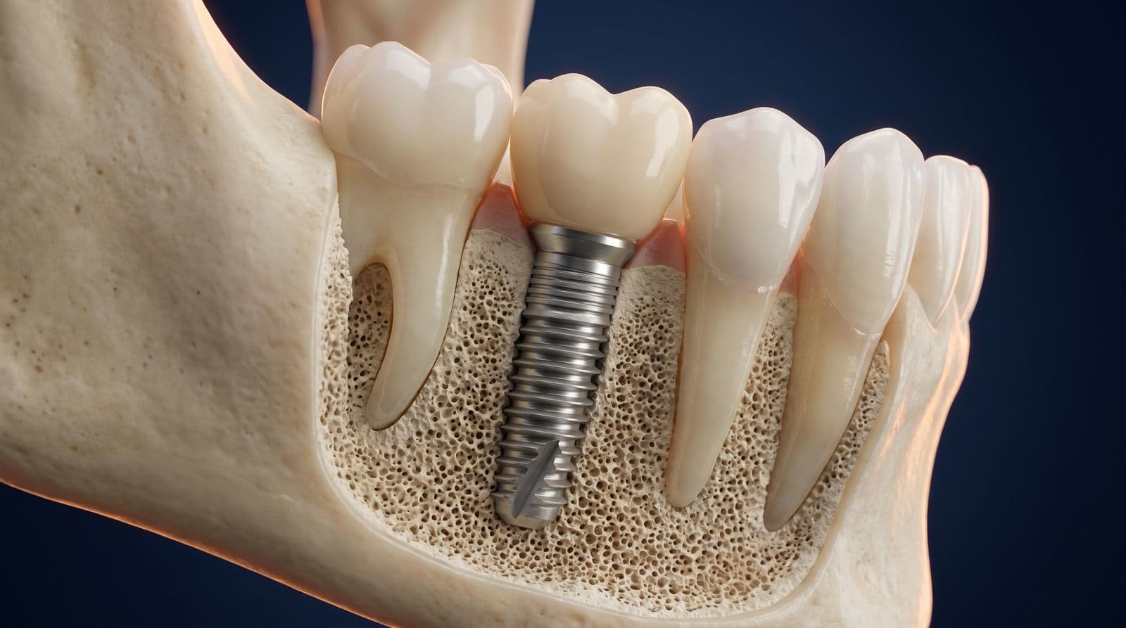 3D Dental Implant Cross-Section in Bangalore by Dr. Srinivas Rao