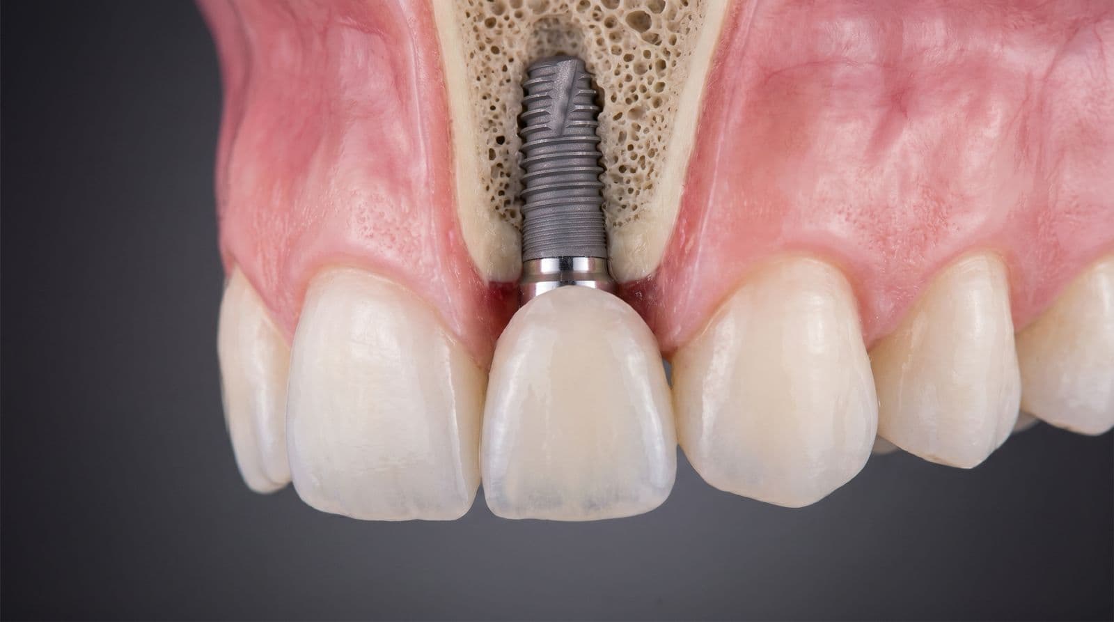 Single Front Tooth Implant Comparison at Maxface Clinic