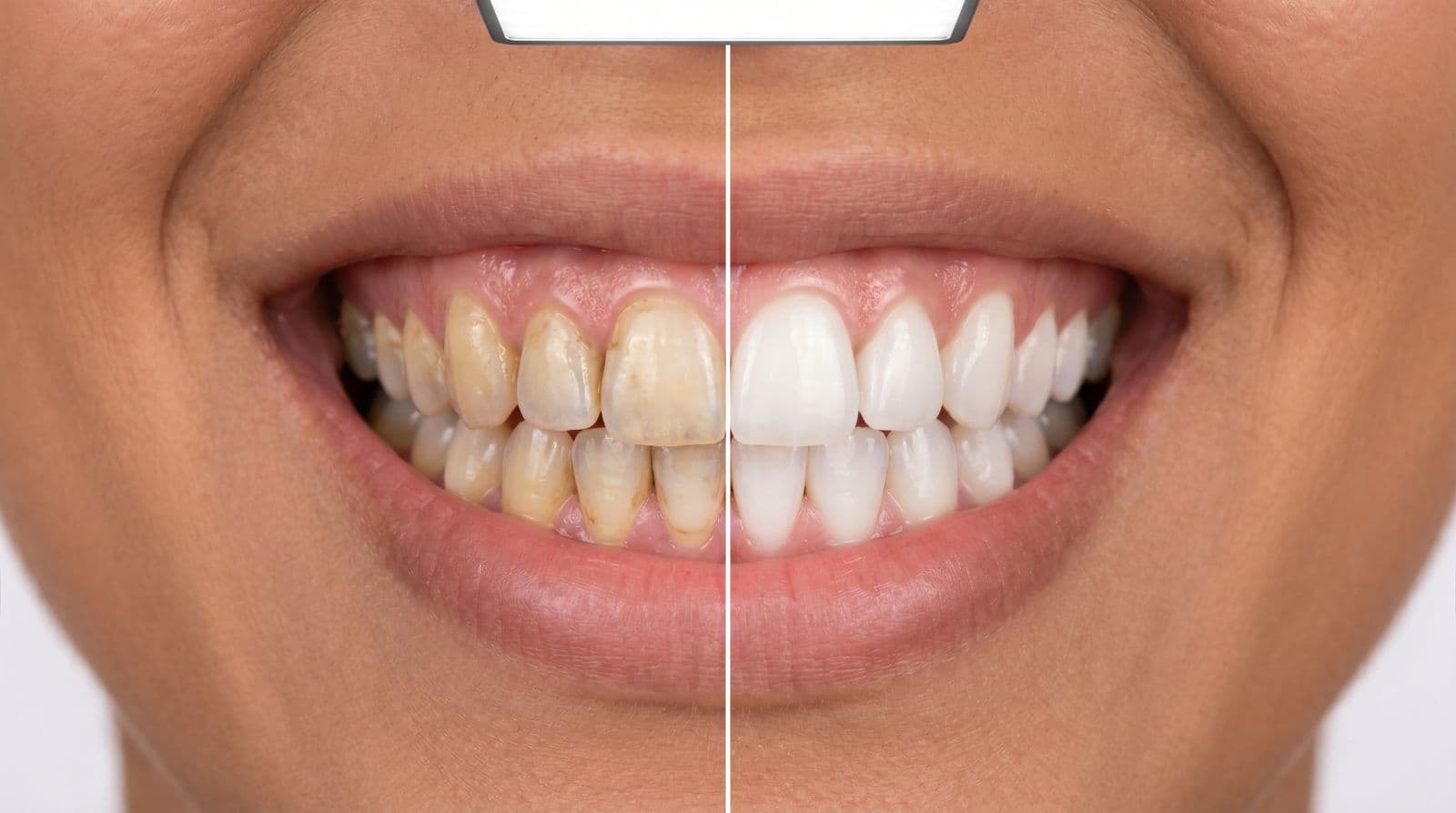 Professional Teeth Whitening Treatment at Maxface Clinic Bangalore