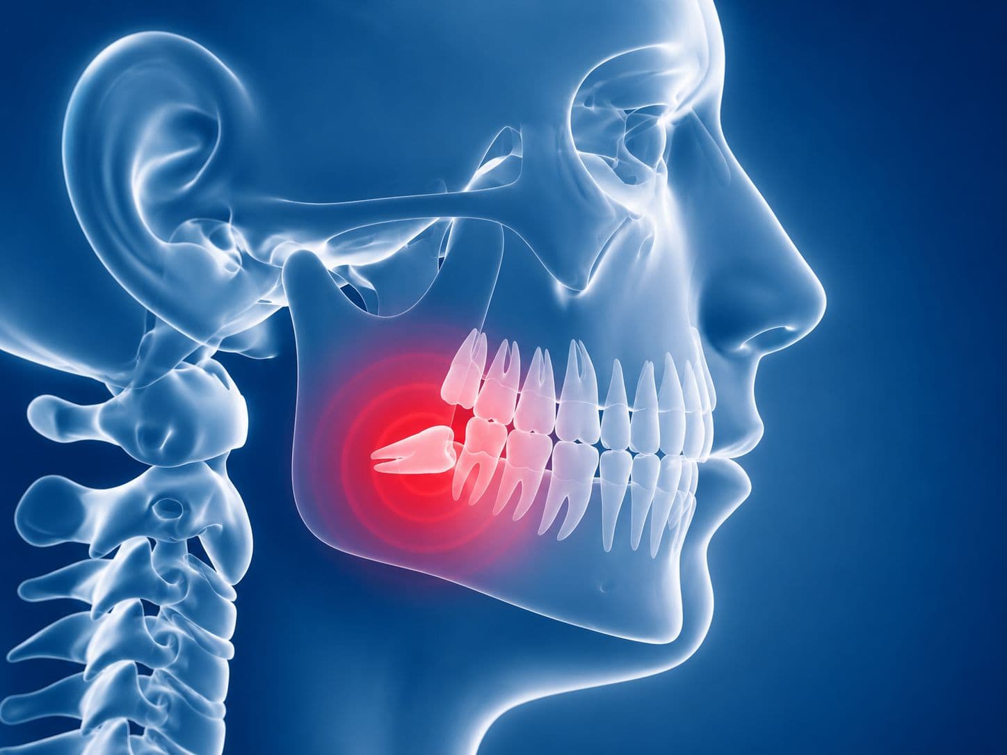 Wisdom Tooth Extraction Surgery at Maxface Clinic Bangalore