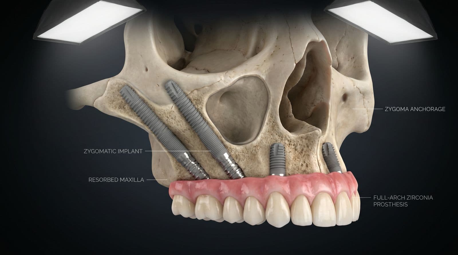 Skull Anatomy & Zygomatic Implant Path by Dr. Srinivas Rao in Kasturinagar