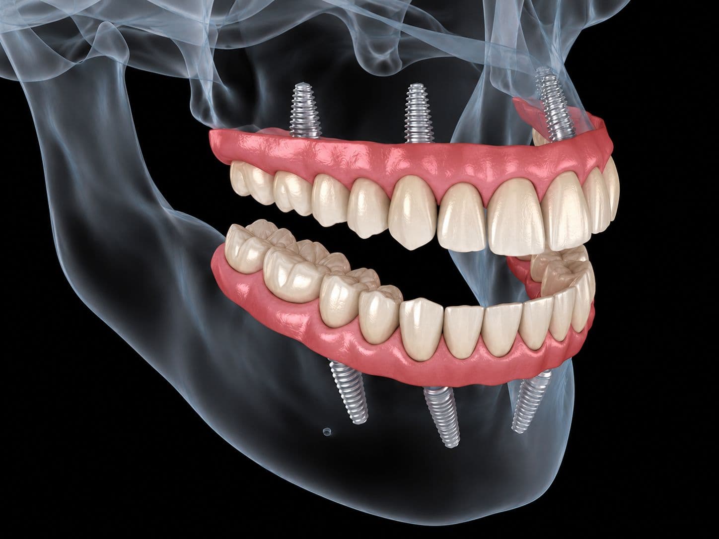 Full Mouth Dental Implants in Bangalore: All-on-4 vs All-on-6 Explained