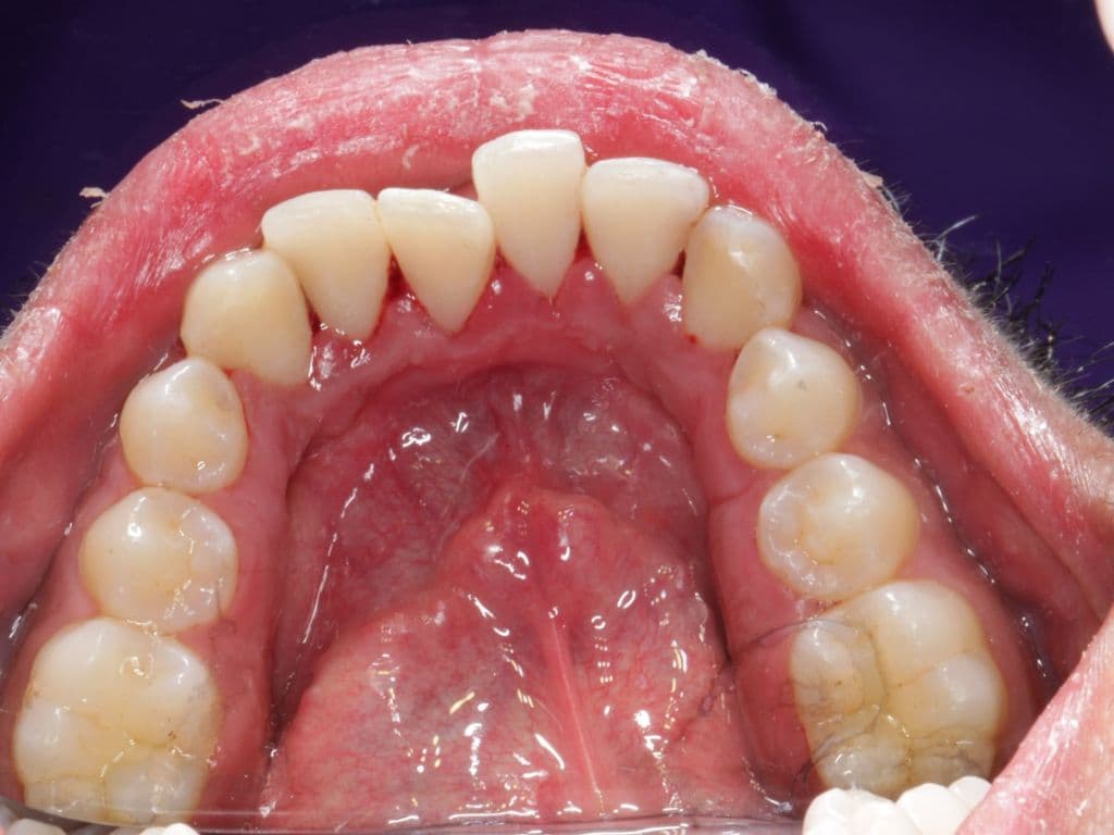 Before - Deep Scaling & Polishing