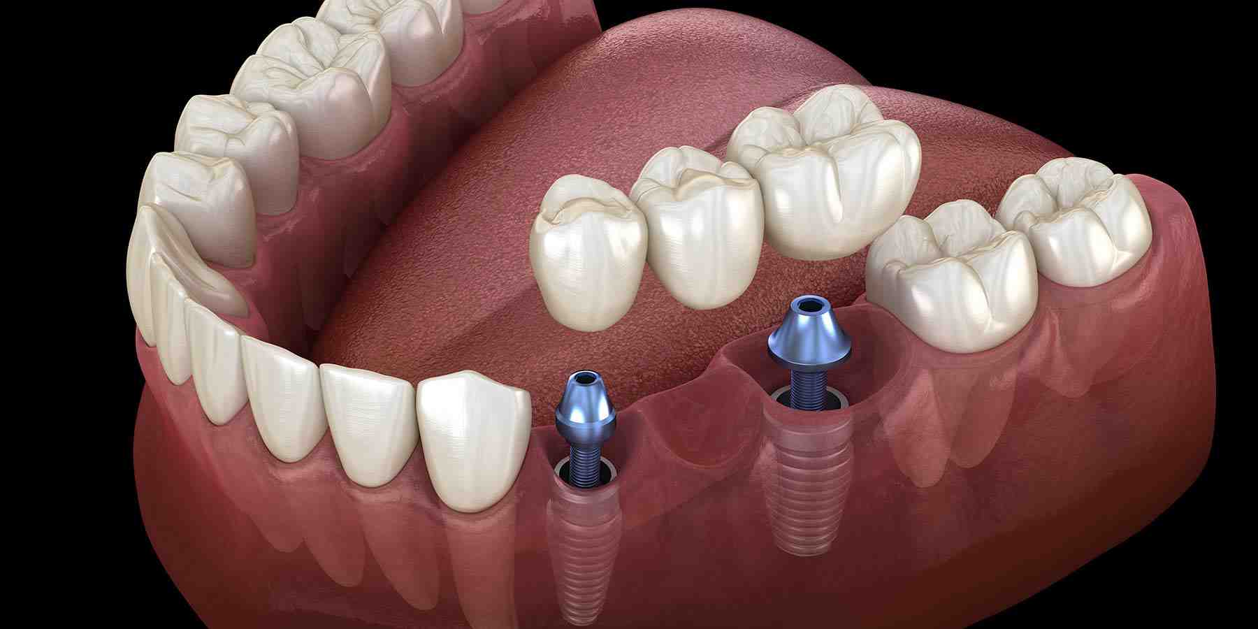 How to Choose the Best Dental Implant Clinic in Bangalore